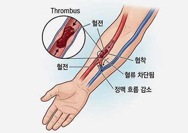 동정맥루 폐색