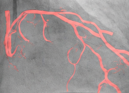 Dynamic Coronary Roadmap